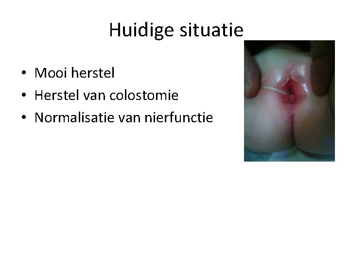 Huidige situatie • Mooi herstel • Herstel van colostomie • Normalisatie van nierfunctie 