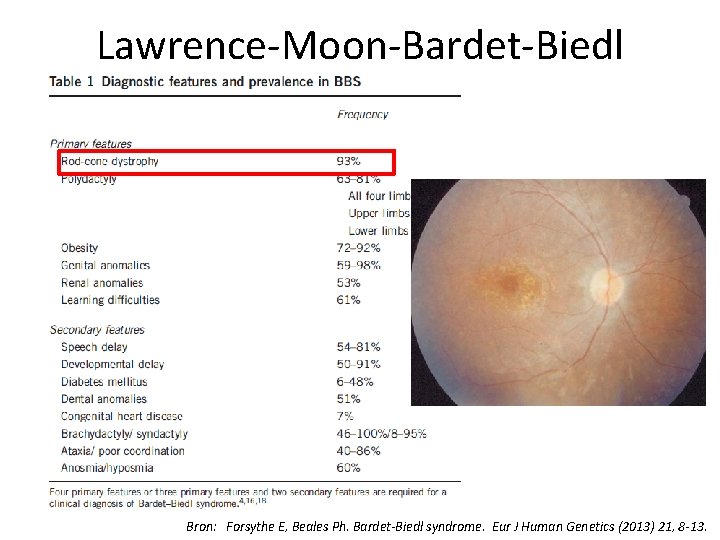 Lawrence-Moon-Bardet-Biedl Bron: Forsythe E, Beales Ph. Bardet-Biedl syndrome. Eur J Human Genetics (2013) 21,