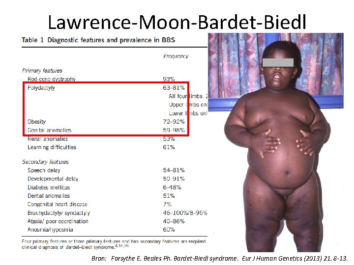 Lawrence-Moon-Bardet-Biedl Bron: Forsythe E, Beales Ph. Bardet-Biedl syndrome. Eur J Human Genetics (2013) 21,