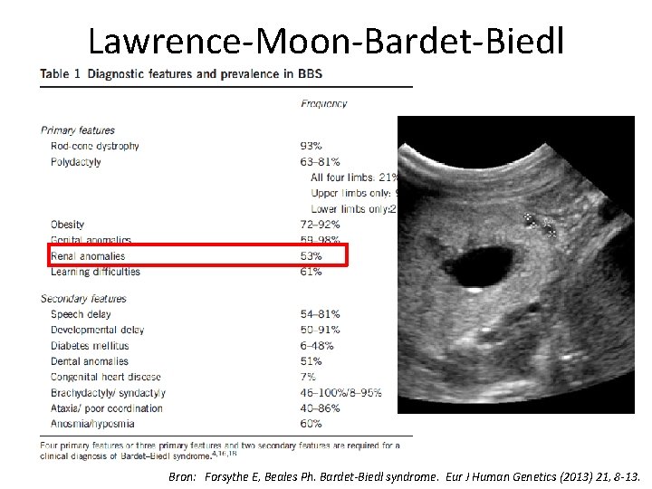 Lawrence-Moon-Bardet-Biedl Bron: Forsythe E, Beales Ph. Bardet-Biedl syndrome. Eur J Human Genetics (2013) 21,