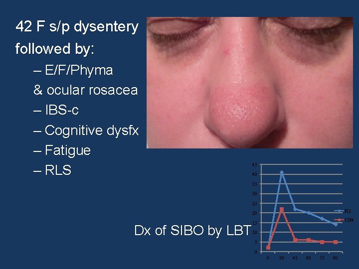 42 F s/p dysentery followed by: – E/F/Phyma & ocular rosacea – IBS-c –