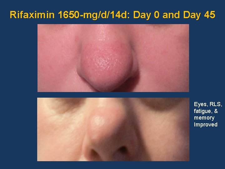 Rifaximin 1650 -mg/d/14 d: Day 0 and Day 45 Eyes, RLS, fatigue, & memory