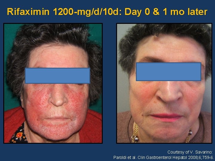 Rifaximin 1200 -mg/d/10 d: Day 0 & 1 mo later Courtesy of V. Savarino: