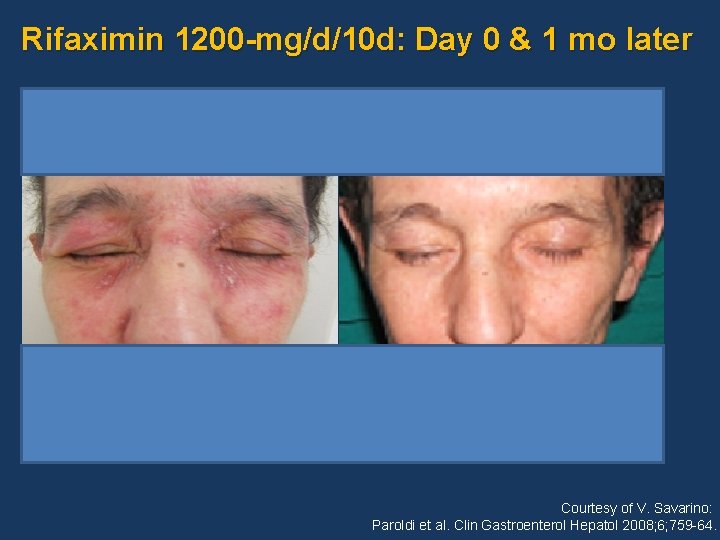 Rifaximin 1200 -mg/d/10 d: Day 0 & 1 mo later Courtesy of V. Savarino: