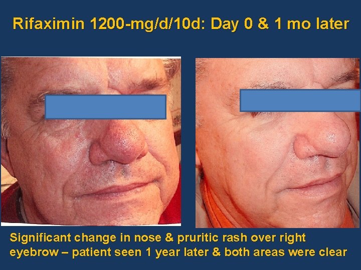 Rifaximin 1200 -mg/d/10 d: Day 0 & 1 mo later Significant change in nose