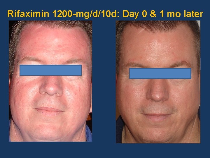 Rifaximin 1200 -mg/d/10 d: Day 0 & 1 mo later 