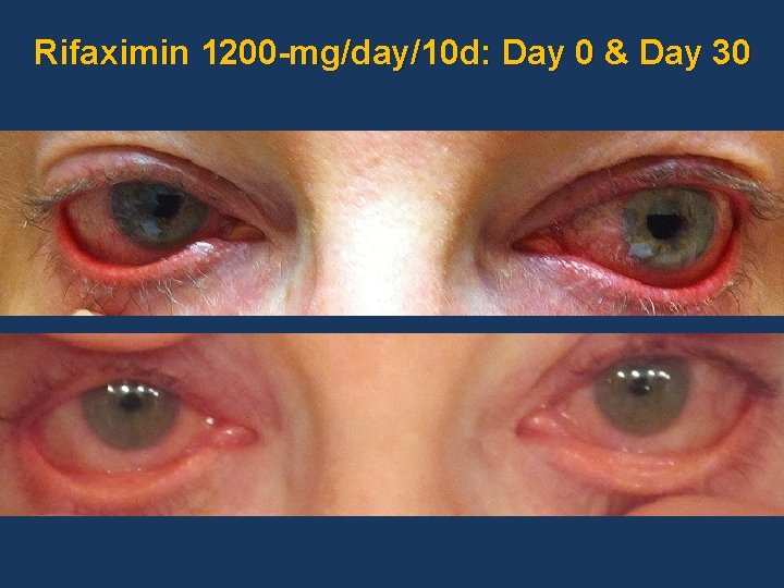Rifaximin 1200 -mg/day/10 d: Day 0 & Day 30 