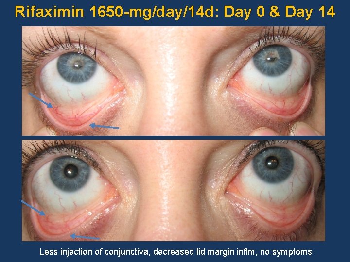 Rifaximin 1650 -mg/day/14 d: Day 0 & Day 14 Less injection of conjunctiva, decreased