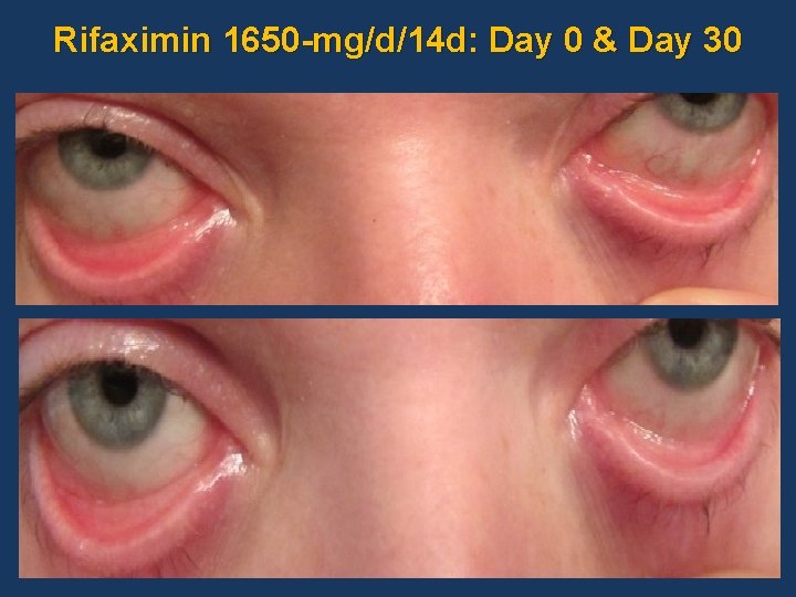 Rifaximin 1650 -mg/d/14 d: Day 0 & Day 30 