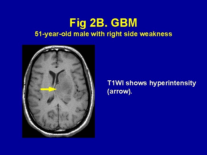 Fig 2 B. GBM 51 -year-old male with right side weakness T 1 WI