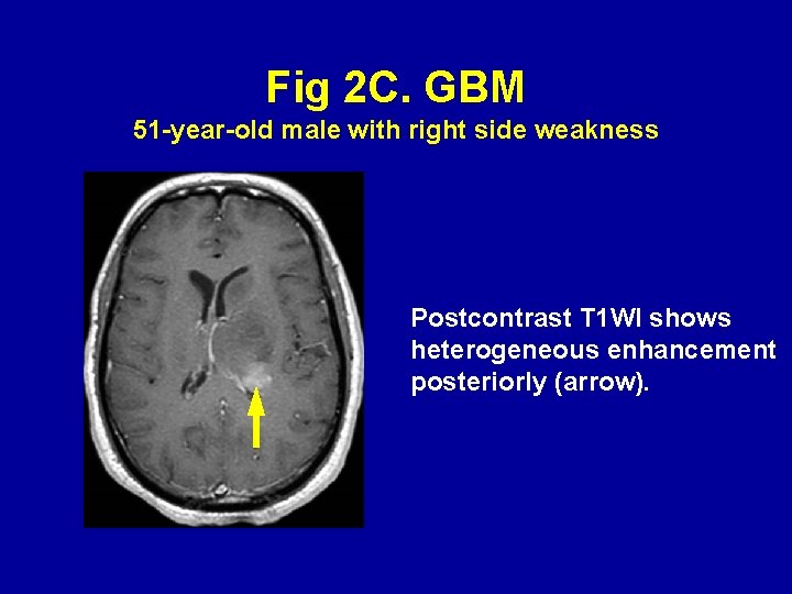 Fig 2 C. GBM 51 -year-old male with right side weakness Postcontrast T 1