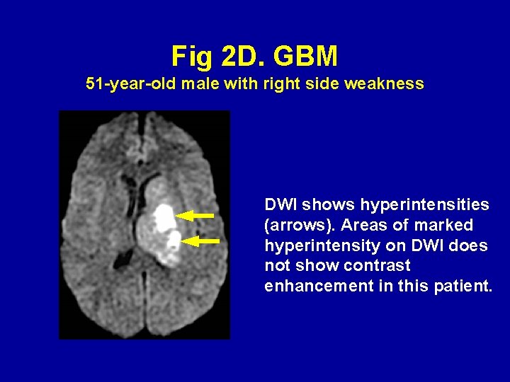 Fig 2 D. GBM 51 -year-old male with right side weakness DWI shows hyperintensities