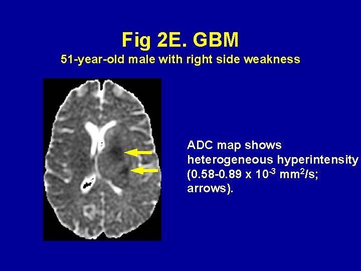 Fig 2 E. GBM 51 -year-old male with right side weakness ADC map shows