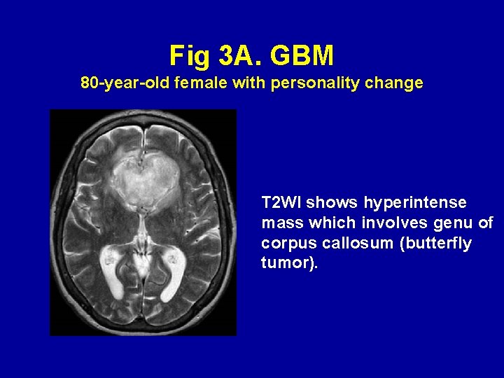 Fig 3 A. GBM 80 -year-old female with personality change T 2 WI shows