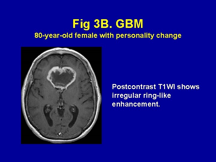 Fig 3 B. GBM 80 -year-old female with personality change Postcontrast T 1 WI