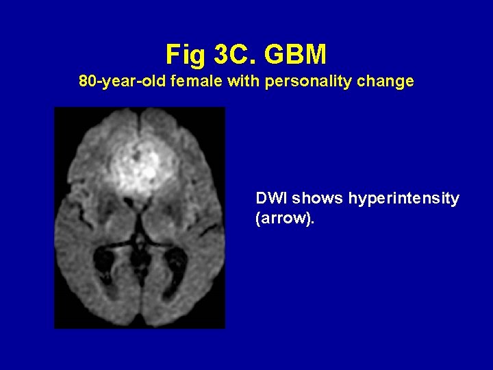 Fig 3 C. GBM 80 -year-old female with personality change DWI shows hyperintensity (arrow).