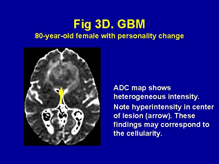 Fig 3 D. GBM 80 -year-old female with personality change ADC map shows heterogeneous