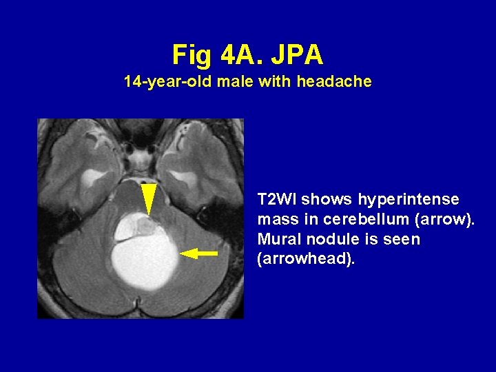 Fig 4 A. JPA 14 -year-old male with headache T 2 WI shows hyperintense