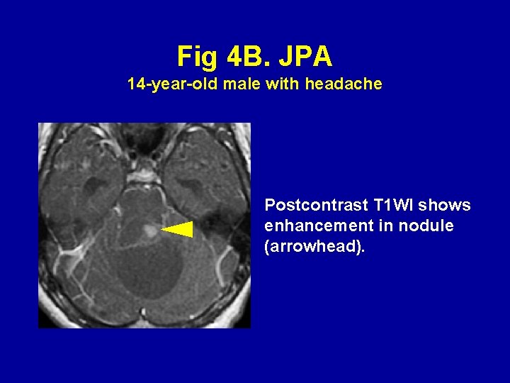 Fig 4 B. JPA 14 -year-old male with headache Postcontrast T 1 WI shows