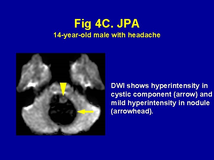 Fig 4 C. JPA 14 -year-old male with headache DWI shows hyperintensity in cystic