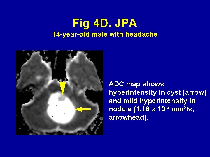 Fig 4 D. JPA 14 -year-old male with headache ADC map shows hyperintensity in