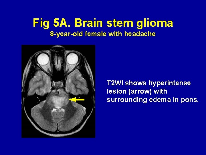 Fig 5 A. Brain stem glioma 8 -year-old female with headache T 2 WI