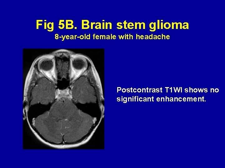 Fig 5 B. Brain stem glioma 8 -year-old female with headache Postcontrast T 1