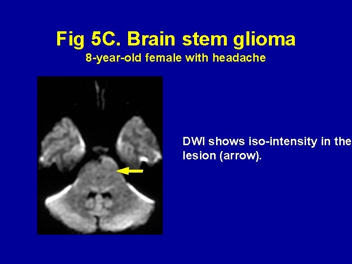 Fig 5 C. Brain stem glioma 8 -year-old female with headache DWI shows iso-intensity
