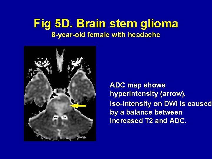 Fig 5 D. Brain stem glioma 8 -year-old female with headache ADC map shows
