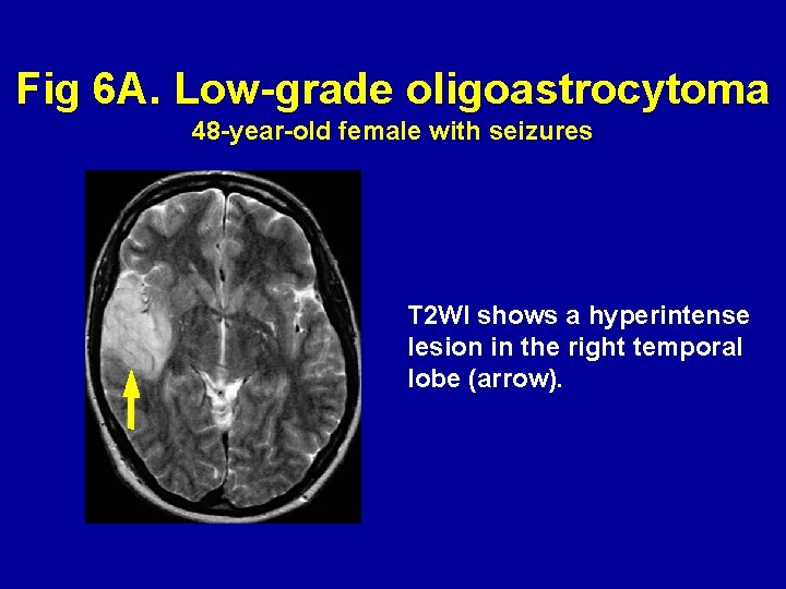 Fig 6 A. Low-grade oligoastrocytoma 48 -year-old female with seizures T 2 WI shows