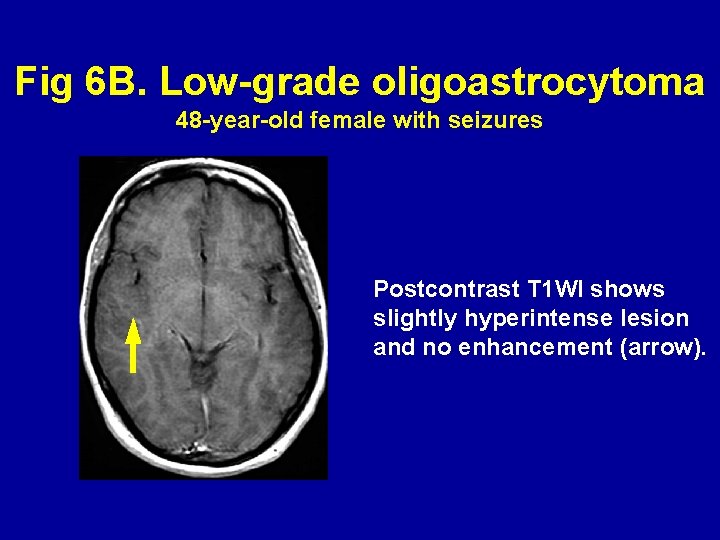 Fig 6 B. Low-grade oligoastrocytoma 48 -year-old female with seizures Postcontrast T 1 WI