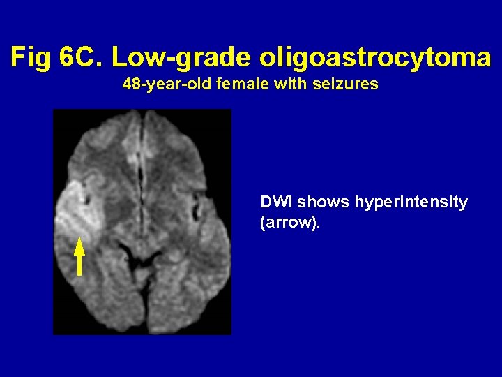 Fig 6 C. Low-grade oligoastrocytoma 48 -year-old female with seizures DWI shows hyperintensity (arrow).