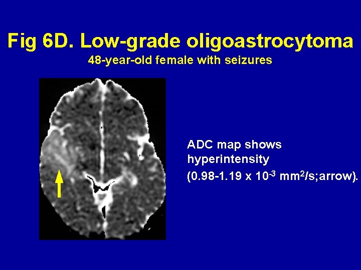 Fig 6 D. Low-grade oligoastrocytoma 48 -year-old female with seizures ADC map shows hyperintensity