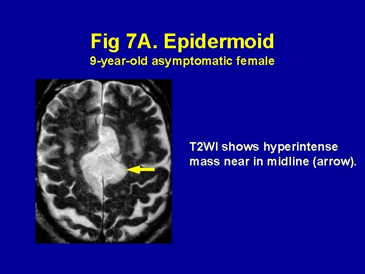 Fig 7 A. Epidermoid 9 -year-old asymptomatic female T 2 WI shows hyperintense mass