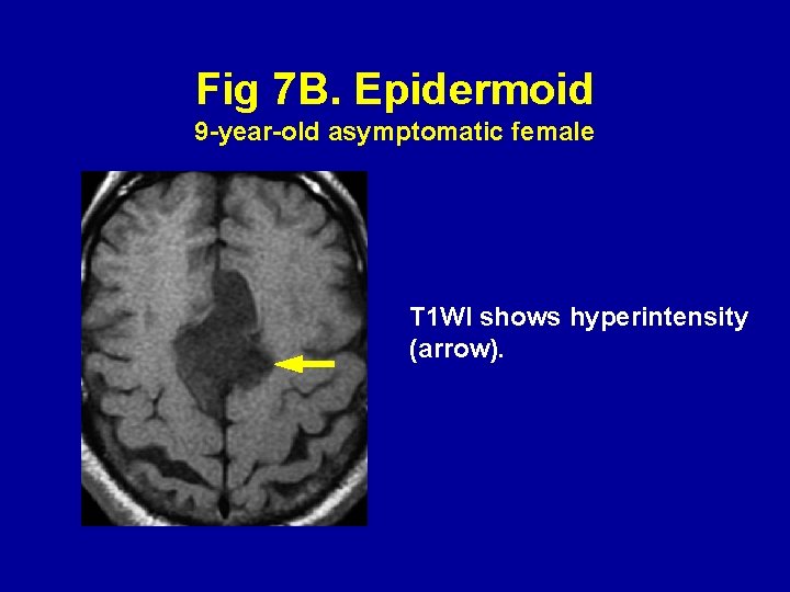 Fig 7 B. Epidermoid 9 -year-old asymptomatic female T 1 WI shows hyperintensity (arrow).