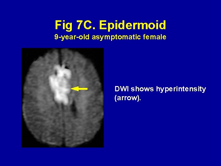 Fig 7 C. Epidermoid 9 -year-old asymptomatic female DWI shows hyperintensity (arrow). 