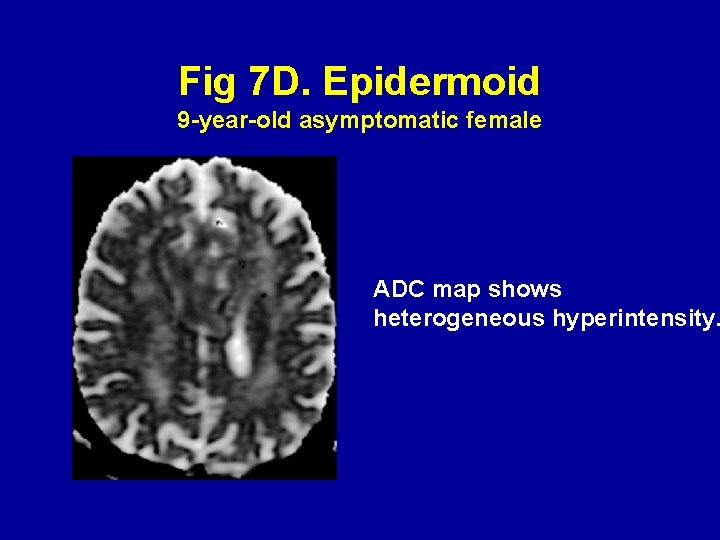 Fig 7 D. Epidermoid 9 -year-old asymptomatic female ADC map shows heterogeneous hyperintensity. 