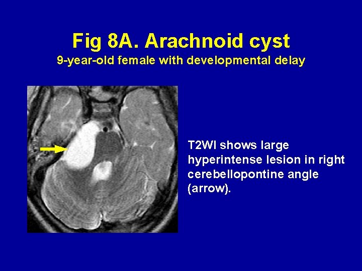 Fig 8 A. Arachnoid cyst 9 -year-old female with developmental delay T 2 WI