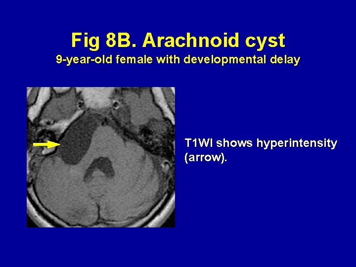 Fig 8 B. Arachnoid cyst 9 -year-old female with developmental delay T 1 WI