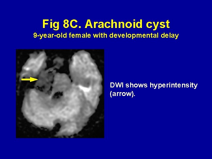 Fig 8 C. Arachnoid cyst 9 -year-old female with developmental delay DWI shows hyperintensity