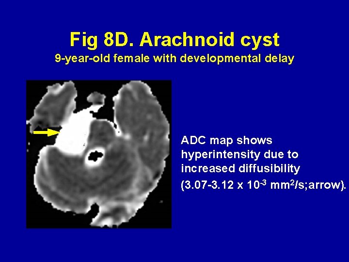 Fig 8 D. Arachnoid cyst 9 -year-old female with developmental delay ADC map shows