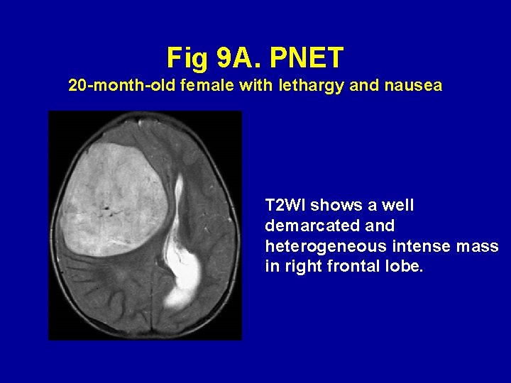 Fig 9 A. PNET 20 -month-old female with lethargy and nausea T 2 WI