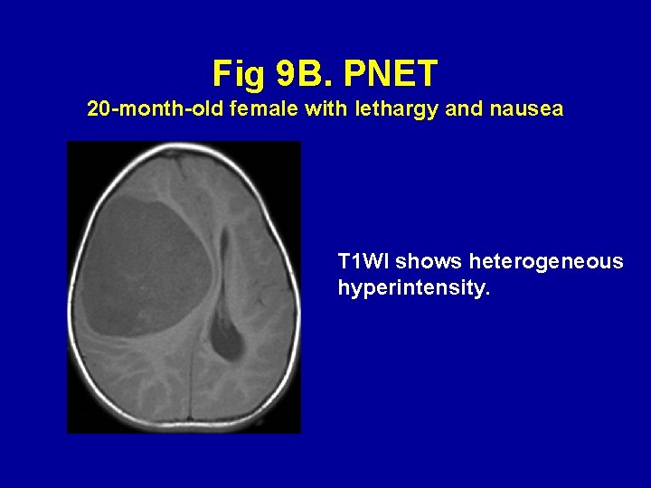 Fig 9 B. PNET 20 -month-old female with lethargy and nausea T 1 WI