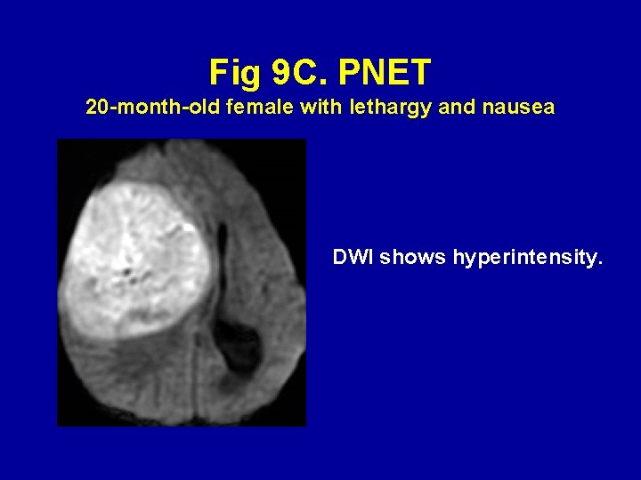 Fig 9 C. PNET 20 -month-old female with lethargy and nausea DWI shows hyperintensity.