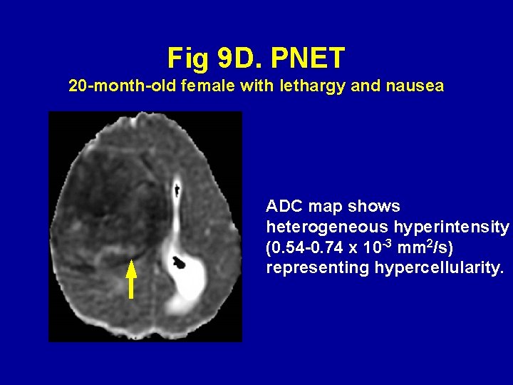 Fig 9 D. PNET 20 -month-old female with lethargy and nausea ADC map shows