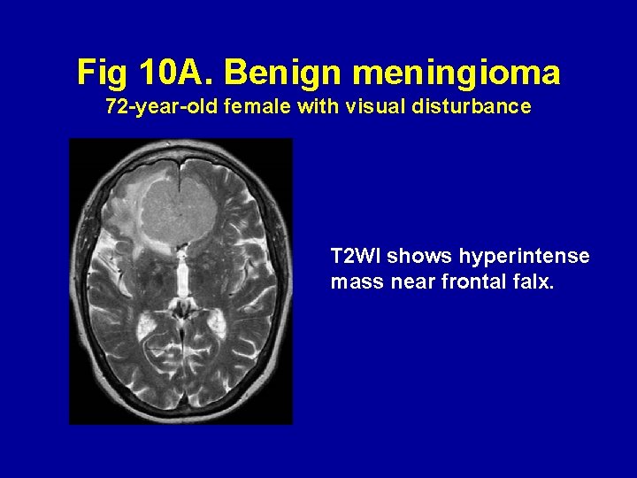 Fig 10 A. Benign meningioma 72 -year-old female with visual disturbance T 2 WI