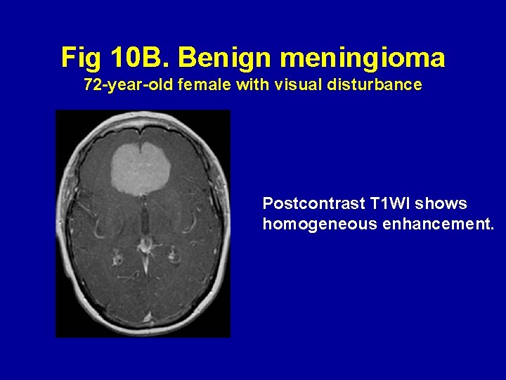 Fig 10 B. Benign meningioma 72 -year-old female with visual disturbance Postcontrast T 1