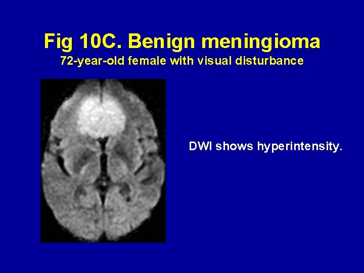 Fig 10 C. Benign meningioma 72 -year-old female with visual disturbance DWI shows hyperintensity.