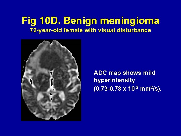 Fig 10 D. Benign meningioma 72 -year-old female with visual disturbance ADC map shows