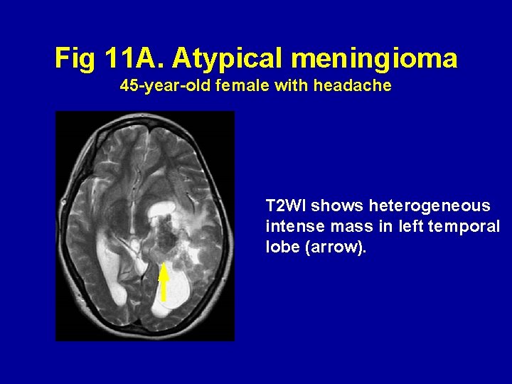 Fig 11 A. Atypical meningioma 45 -year-old female with headache T 2 WI shows